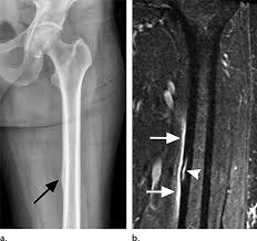 The gracilis is a superficial muscle of your groin and inner thigh that serves to adduct your hip. Adductor Insertion Avulsion Syndrome In A 26 Year Old Woman With 8 Download Scientific Diagram