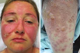 Bullae and Atypical Target Lesions in a Young Woman