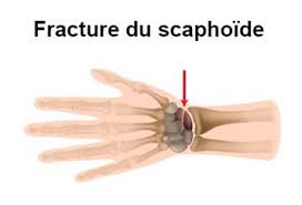 Les douleurs à la main sont très fréquentes. Douleur De La Main Symptomes Traitement Definition Docteurclic Com