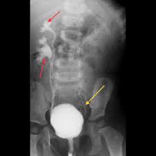 Image result for Voiding Cystourethrogram