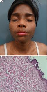 Natural treatments natural remedies lichen planus pictures lichen planus cure lichen lichen planus is an inflammatory immune system issue of your skin or mucous membranes. A Clinical Morphology Of Lichen Planus Pigmentosus Patient Download Scientific Diagram
