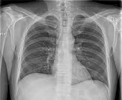 Chest x ray normal labelled. Practice Chest X Ray Interpretation