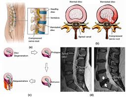 Check spelling or type a new query. Percutaneous Endoscopic Lumbar Spine Surgery For Lumbar Disc Herniation And Lumbar Spine Stenosis Emphasizing On Clinical Outcomes Of Transforaminal Technique