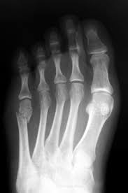 Fractures of the proximal fifth metatarsal: Fifth Met Fractures And Osteoporosis In Women Lower Extremity Review Magazine