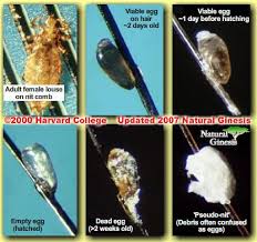 Head lice eggs (nits) are brown or white (empty shells) and attached to the hair. Natural Ginesis Head Lice