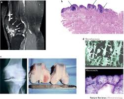 Image result for Limbrel