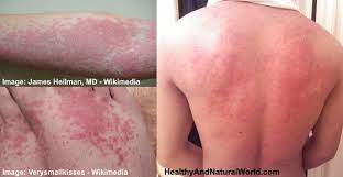 Natural Tricks To Get Rid Of Hives Allergy Hives Get Rid Of Hives Hives Treatment