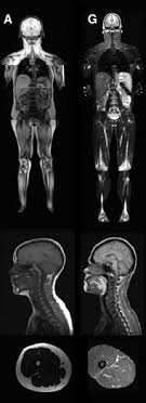 For more pronunciations, subscribe to my channel. Congenital Generalized Lipodystrophy Wikipedia