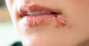 6 โรคติดต่อทางเพศสัมพันธ์ รักแต่ไม่ป้องกัน ระวังสายเกินแก้ - โรงพยาบาลวิมุต