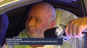 The clinical, histological, and immunological features of fs are not distinguishable from those of nonendemic pf (11, 12); Fogo Selvagem Homem Sofre Com Doenca Que Provoca Bolhas E Deixa Feridas E Precisa De Ajuda Youtube