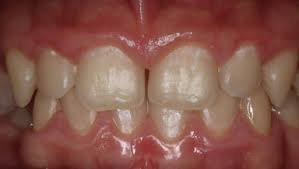 Management Of White Spot Lesions Intechopen