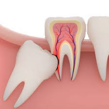 In some patients, it is as early as 12 or 13 years of age and in others, it may not be until the early twenties. 3rd Molar Extractions Wisdom Teeth Removal Cost And Prices In Mexico 2019