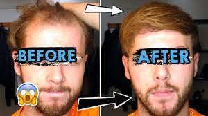 Alpecin can help keeps the hair roots active. Does Alpecin Caffeine Shampoo Reverse Hairloss The Truth Revealed Youtube