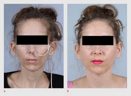 Ernstige malnutritie na gastric bypass