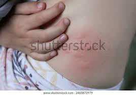 Image result for spinne biss haut reaktion