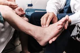Image result for Peripheral Neuropathy