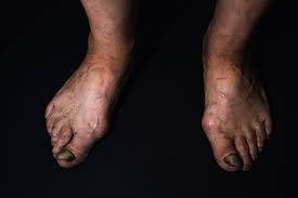 Image result for Onycholysis feet