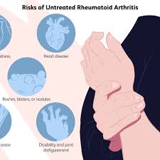 Rheumatoid arthritis is an inflammatory type of arthritis that can causes joint pain, swelling and damage. Risks Of Untreated Rheumatoid Arthritis