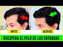 Como Hacer Crecer El Cabello De Las Entradas Recuperar El Cabello Remedios Caseros Andyzaturno Youtube