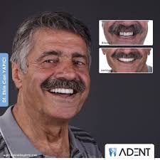 implant tedavisi once sonra instagram estetik yuzler