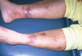 Cutaneous tuberculosis, tuberculosis of skin, cutaneous tb, tuberculosis cutis, tuberculoderma. Https Www Racgp Org Au Afpbackissues 2006 200607 20060705leow Pdf