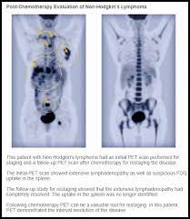 The pet scanner detects signals that are given off from the tracer. Pet Imaging In Hematology Ask Hematologist Understand Hematology