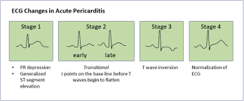 Pericarditis vs benign early repolarisation. Cups To Manage Pericarditis The Journal For Nurse Practitioners