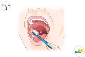 Mar 22, 2019 · some people also try to remove a tonsil stone with the back of a toothbrush. How To Get Rid Of Tonsil Stones Fast And Easily Fab How