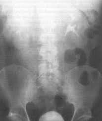 Image result for Intravenous Pyelogram