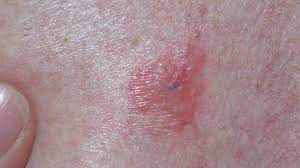 Skin cancer is one of the most common forms of cancer and can appear anywhere on the skin. Skin Cancer Symptoms Pictures Types And More