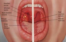 Throat cancer is a cancer which can occur anywhere on our mouth behind the nose, which is called as pharynx or inside the voice. Sore Throat Meaning In Tamil