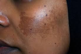 Image result for Melasma
