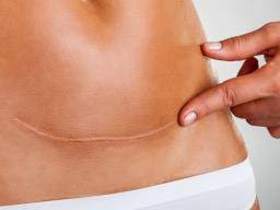 It's also known as form 1040. C Section Procedure Risks And Recovery