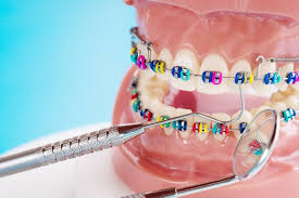 Brush in little circles, between the wires and gums on the upper and lower teeth to loosen the food particles throughout your entire mouth, which includes all chewing surfaces, behind the teeth, and gum tissue. Premium Photo Face Of A Young Smiling Asian Woman With Braces On Teeth Orthodontic Treatment