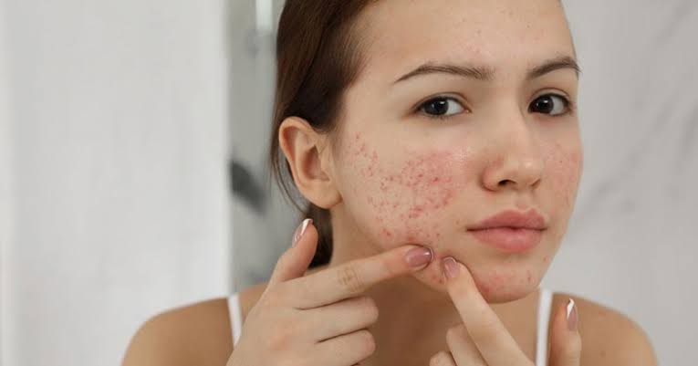Best Acne Treatment in Dubai | Euromed Clinic