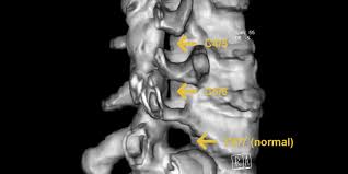 Cervical Foramenstenose Gemeinschaftspraxis Fur Neurochirurgie