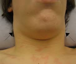 Mono is spread through saliva. Infectious Mononucleosis Wikipedia