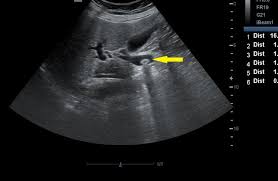 Image result for Choledocholithiasis