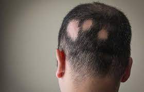 Dreams Of Hair Falling Out Meaning And Interpretations