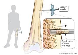 It is composed of different biological matrices such as circulating tumor cells (ctcs), cell free nucleic acids, exosomes or t … Bone Biopsy Using Image Guidance