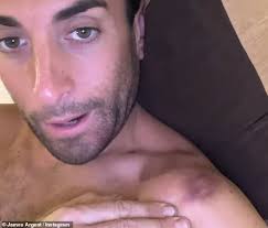 James Argent shows off his shocking injuries from SAS: Who Dares Wins