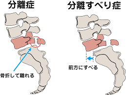 腰椎分離症 | 八王子市めじろ台・狭間・山田・高尾 はりきゅう整骨院イシイ