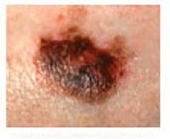 Melanoma Warning Signs And Images The Skin Cancer Foundation