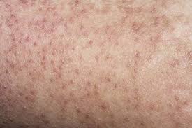 Image result for Keratosis pilaris