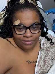 Just had mini bypass 07/15 doing well little pain