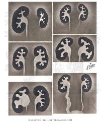 Image result for Intravenous Pyelogram