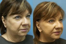 I couldn't be any simpler with my nutrition recommendations for fat burning. How Can I Get Rid Of Sagging Jowls Daytona Beach Ultherapy Dr Schalit Facial Cosmetic Surgeon