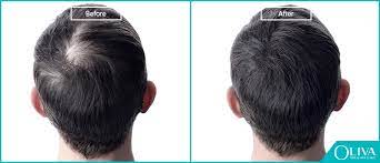 Polycystic ovaries can also accelerate the condition, and genetic hair. Teenage Hair Loss Causes Treatments And Prevention