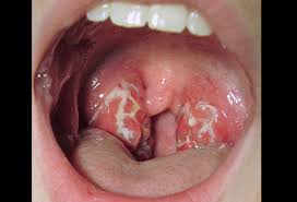 Symptoms of lymphoma in children ile ilgili görsel sonucu