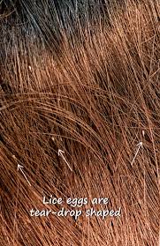 Be it brown or white, you must include eggs in your daily diet to enjoy its. Pictures Of What Lice Eggs Nits Look Like In Hair 9 Tips To Spot Them